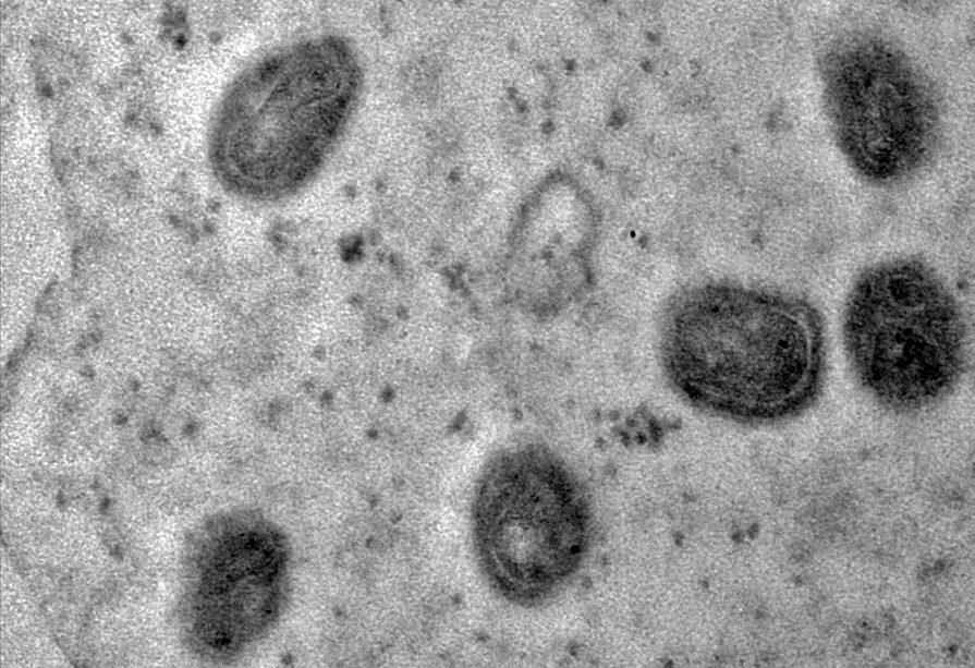 Paciente com suspeita de Mpox é isolado e transferido para o Hospital Luiz Palmier, em São Gonçalo